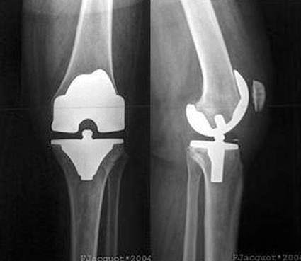 Image: Radiographic images of Total Knee Replacement (photo courtesy Wikipedia).